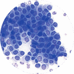 Citologia Oncótica Líquidos Cavitários, Secreções e Raspados